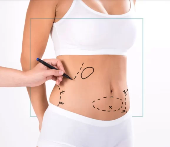 When is the best time to consider lipo 360?